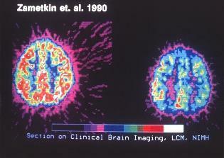 exploración clínica de imágenes cerebrales para el TDAH