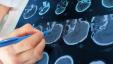 Los escáneres cerebrales 3D pueden aumentar la precisión del diagnóstico de TDAH