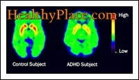 Los términos ADD y ADHD se han usado indistintamente. Sin embargo, el término actualizado, según el DSM IV, es TDAH (trastorno por déficit de atención con hiperactividad).