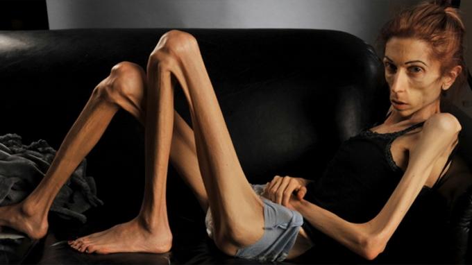Trastornos de la alimentación: anorexia nerviosa: la enfermedad mental más mortal